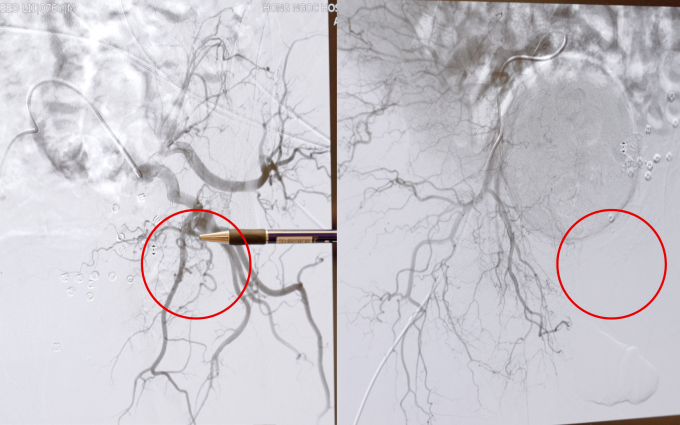 Freeds prostate before embolization (L) and after embolization (R). Photo courtesy of Hong Ngoc General Hospital
