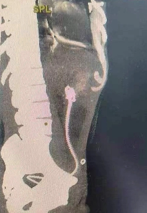 A CT scan image of a live eel in a mans intestines. Photo courtesy of First Affiliated Hospital of Hunan University of Chinese Medicine
