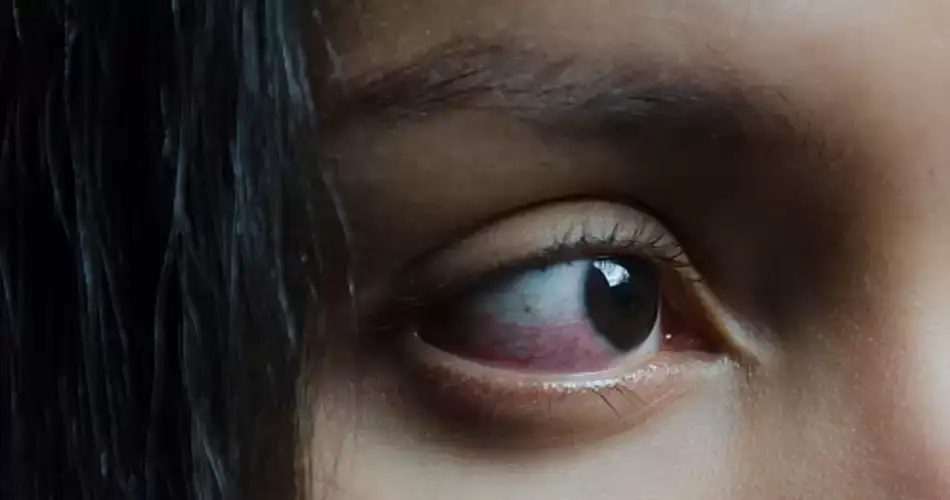 Home remedies to deal with the problem of watery eyes