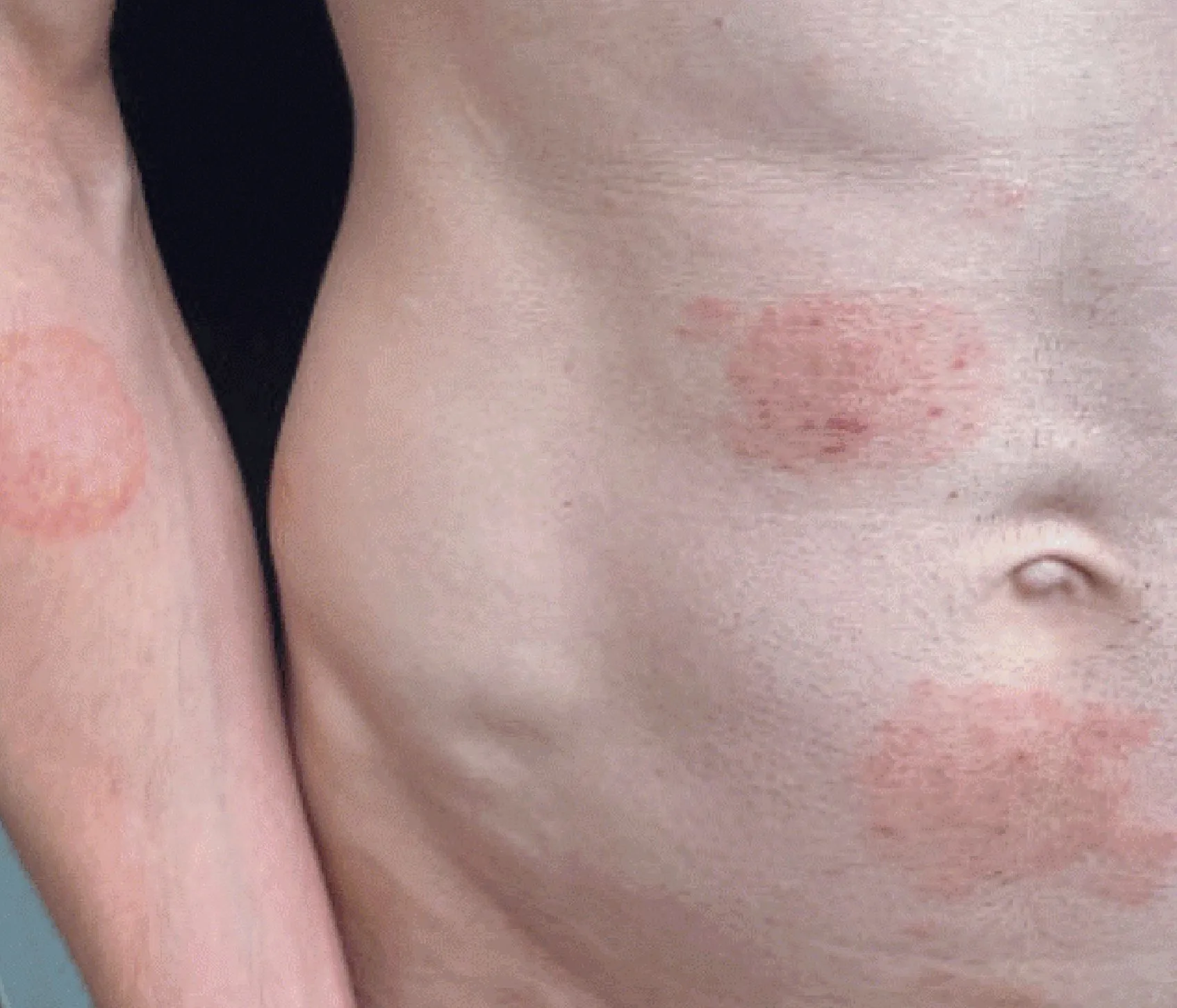 A human torso and arm showing multiple red, circular, and irregularly shaped rashes on the skin.