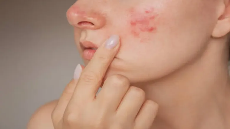 Problem of pimples and acne on face due to wet hair