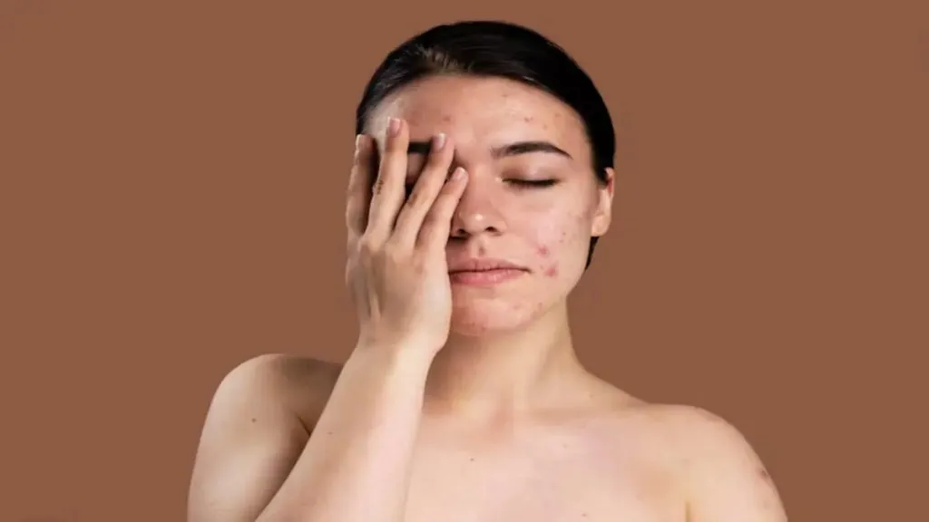 Seborrheic Keratoses