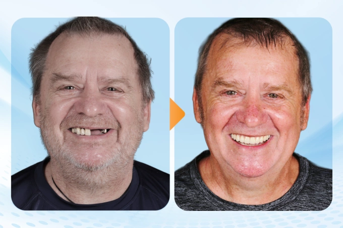 Norbert Eberhardt before and after completing implant treatment at Dr. Care Implant Clinic in HCMC. Photo courtesy of Dr. Care