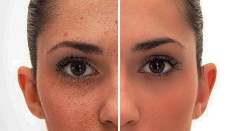 Blue Light Effects on Skin causing digital ageing and wrinkles