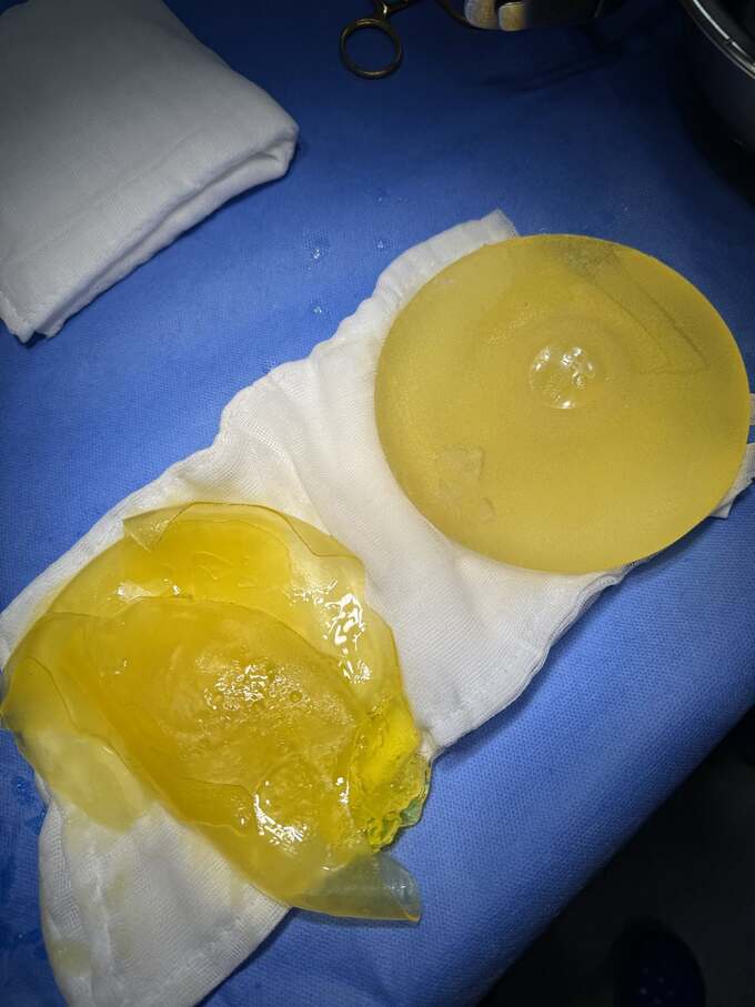Textured breast implant rupture after 8 years. Photo courtesy Dr. Ho Cao Vu