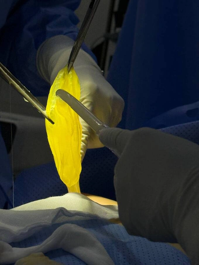 Breast implant rupture 7 years after breast augmentation. Photo courtesy Dr. Ho Cao Vu