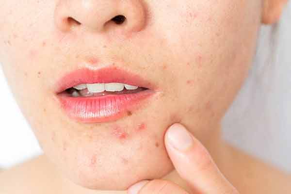 Acne after makeup? Mira Kapoor reveals 3 common skincare mistakes